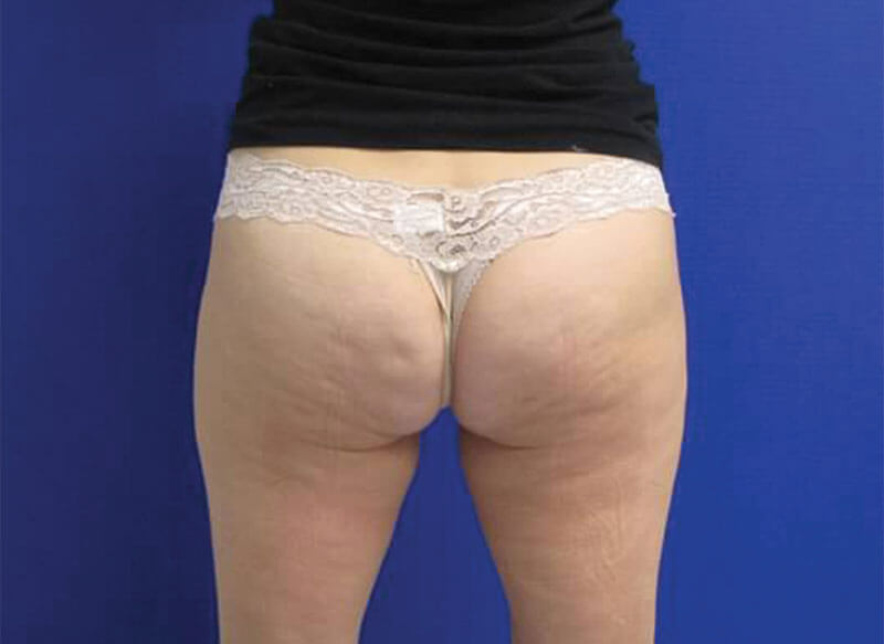 CoolSculpting Butt Before & After_ Before Picture_ Injectable Aesthetics