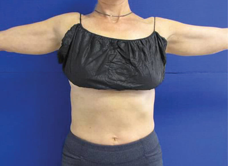 CoolSculpting OKC - Arm Fat Before and After Photo