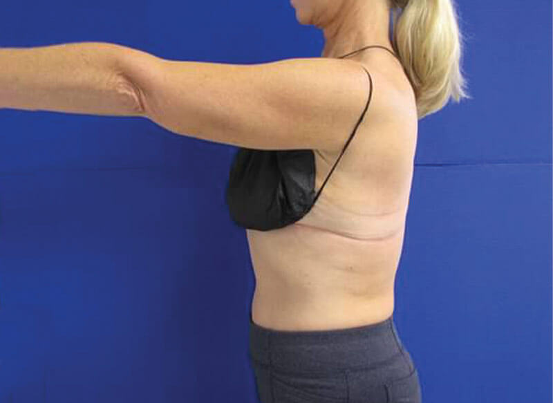 CoolSculpting OKC - Arm Fat Before and After Photo