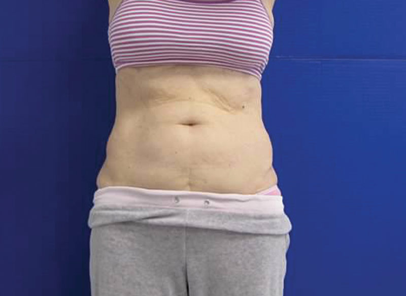 CoolSculpting Belly Before & After_ Before Picture_ Injectable Aesthetics