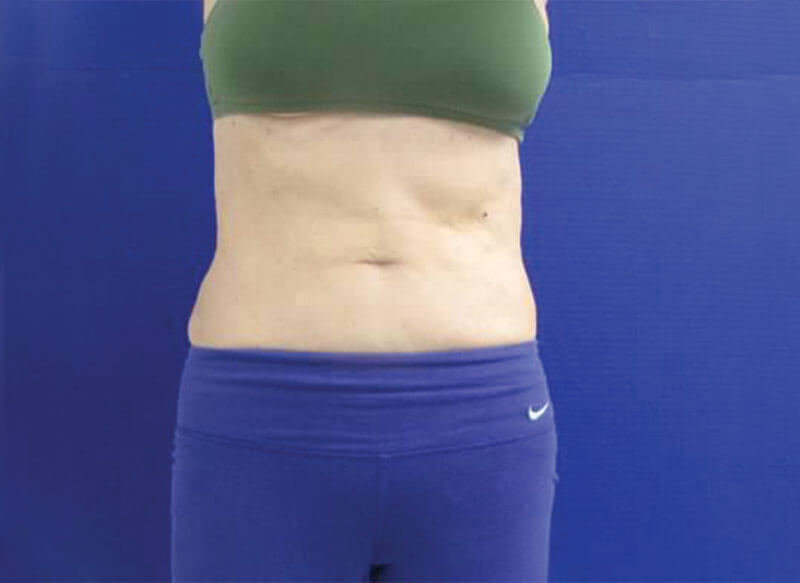 Client-L2_AFTER-front--CoolSculpting-Before-&-After-_-Injectable-Aesthetics-Oklahoma-City