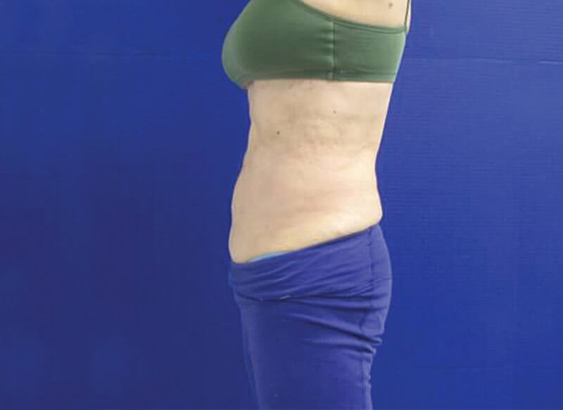CoolSculpting Belly Before & After_ After Picture_ Injectable Aesthetics