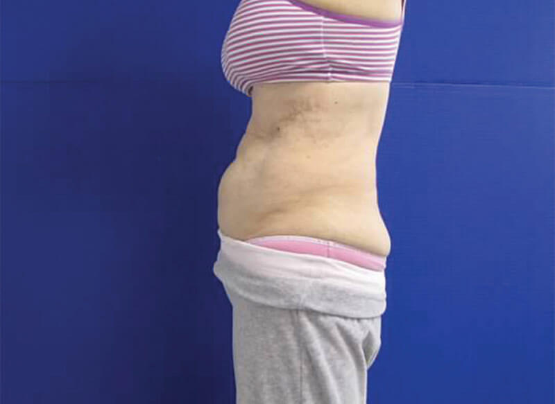 CoolSculpting Belly Before & After_ Before Picture_ Injectable Aesthetics