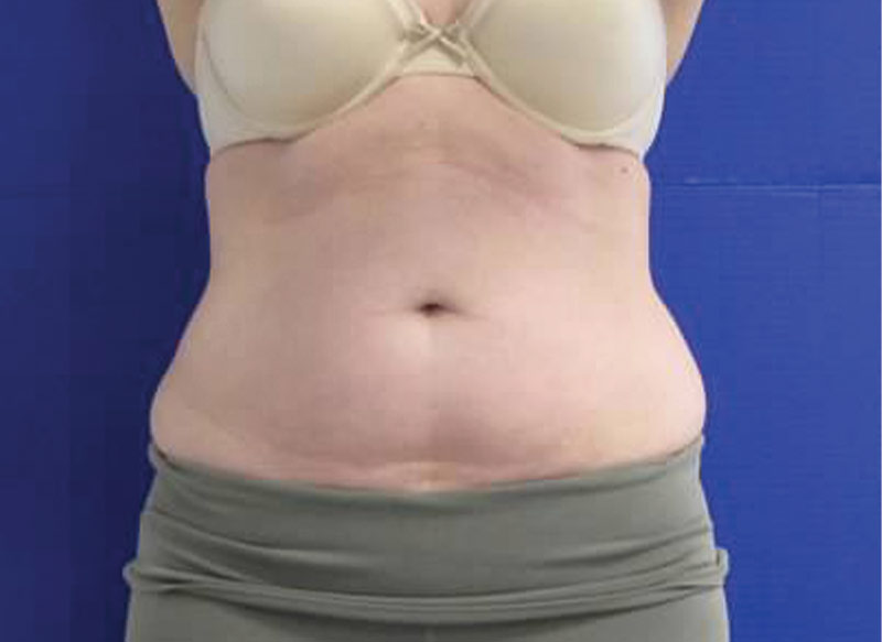 Client-L_BEFOREfront--CoolSculpting-Before-&-After-_-Injectable-Aesthetics-Oklahoma-City
