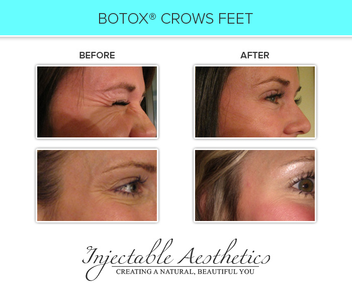 Botox Crows Feet