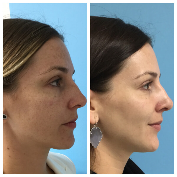 IPL PhotoFacial Before and After _ Injectable Aesthetics OKC