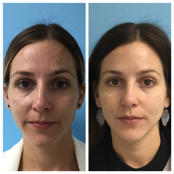 IPL PhotoFacial Before and After _ Injectable Aesthetics OKC