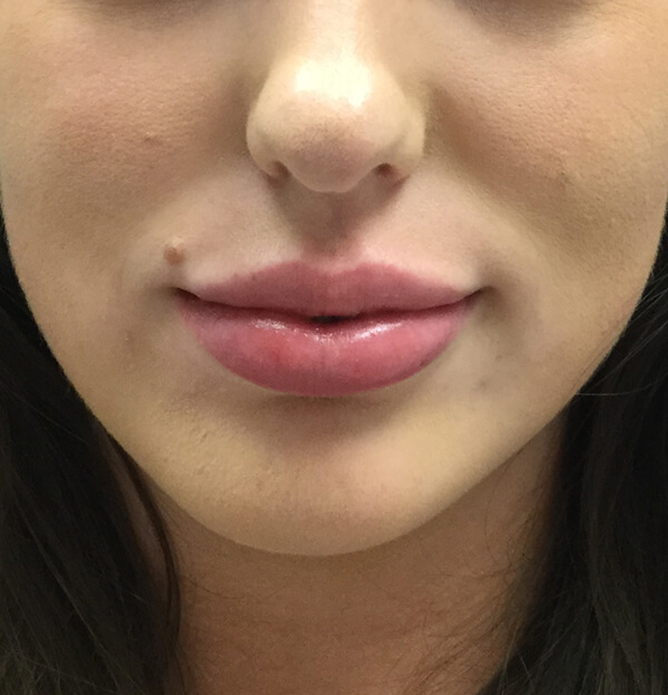 Best Lip Filler OKC - Injectable Aesthetics Lip Filler Before and After