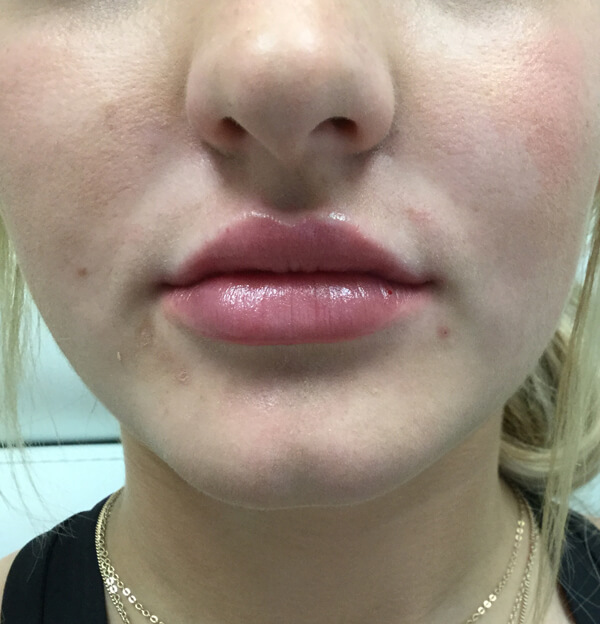 Best Lip Filler OKC - Injectable Aesthetics Lip Filler Before and After