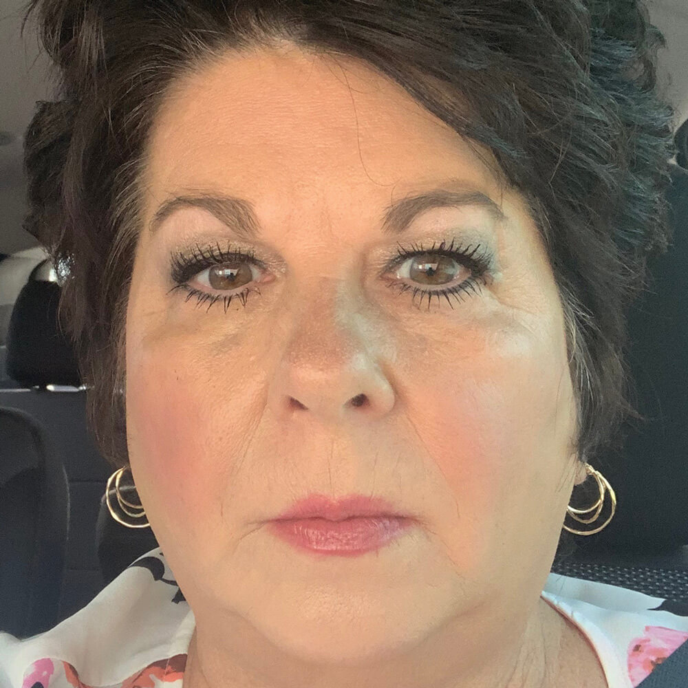 Liquid Facelift Before and After - After