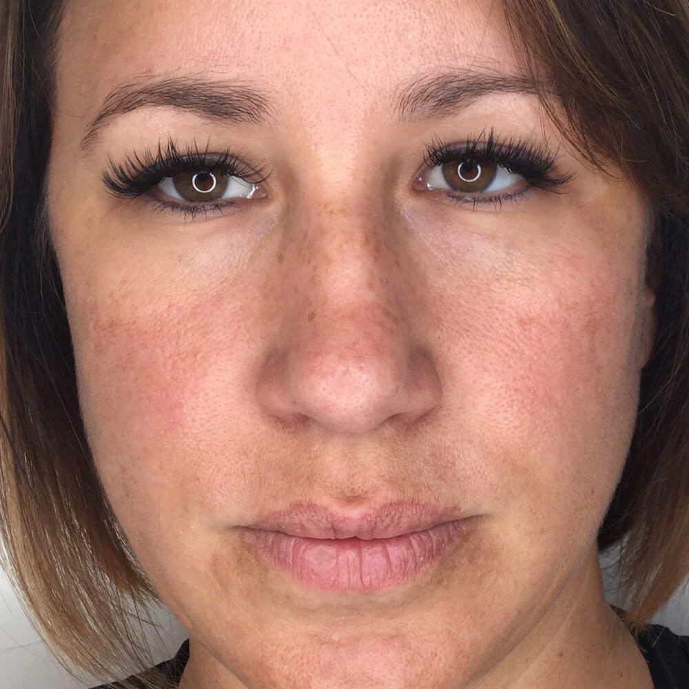 Under Eye Filler Injectable Aesthetics Before and After