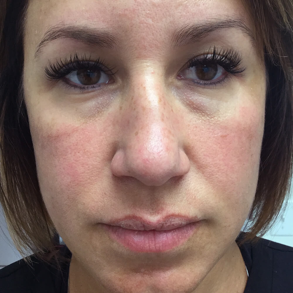Under Eye Filler Injectable Aesthetics Before and After