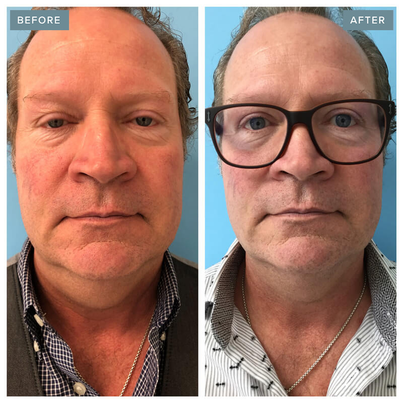 Male Thread Lift Before and After - Injectable Aesthetics