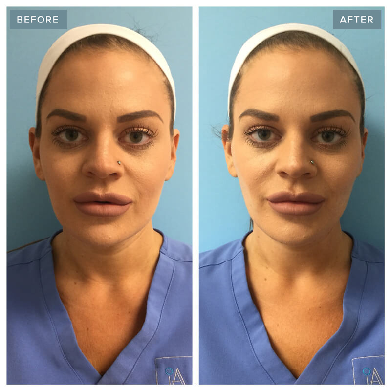 Thread Lift Before and After - Injectable Aesthetics