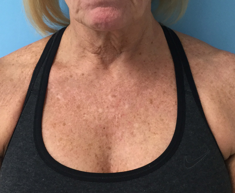 IPL Laser Treatment on Chest_Injectable Aesthetics Before