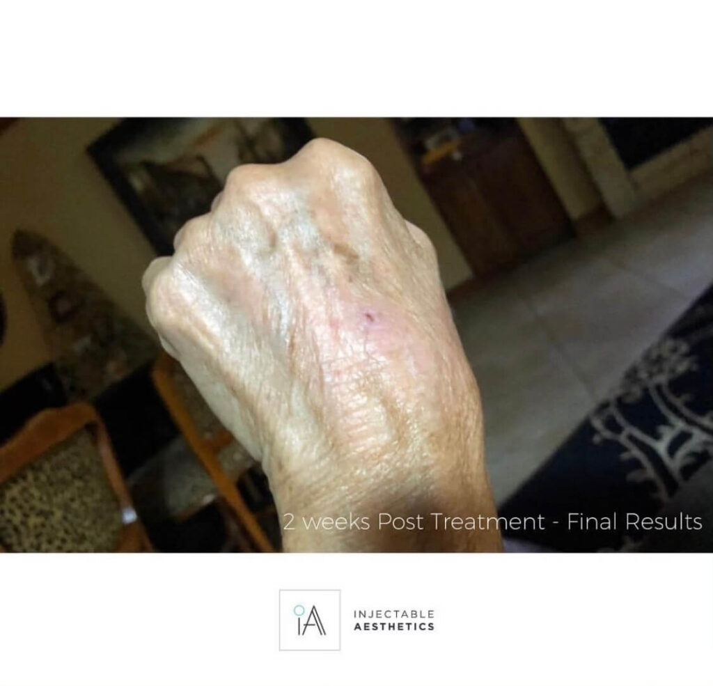 IPL Laser Treatment OKC FAQs, Before & After Injectable Aesthetics