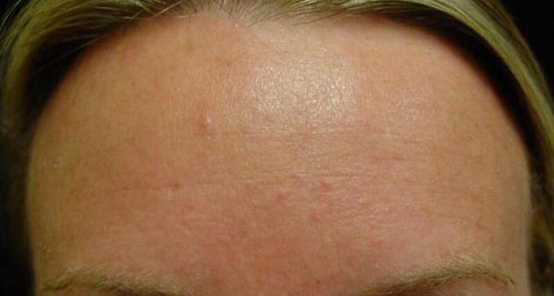 Mens Botox Forehead After