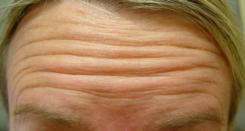 Mens Botox Forehead Before