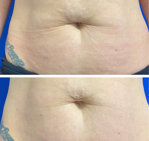 Morpheus8-Before-and-After Stomach